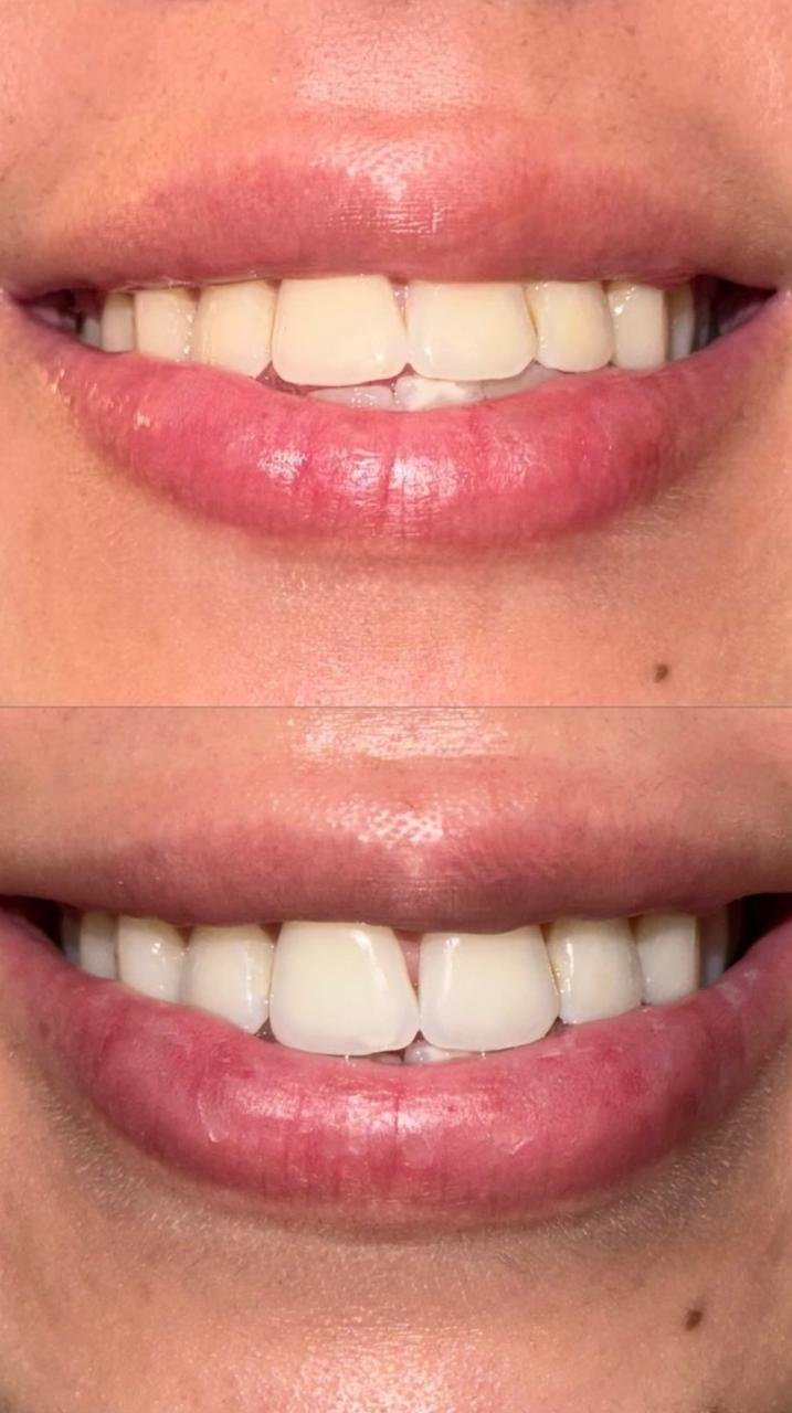 Before and after using the AURÉVA V34 routine