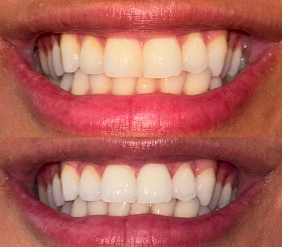 Before and after using the AURÉVA V34 routine