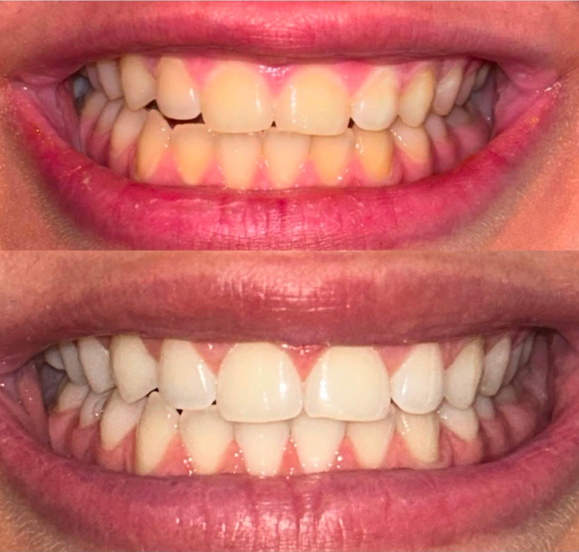 Before and after using the AURÉVA V34 routine